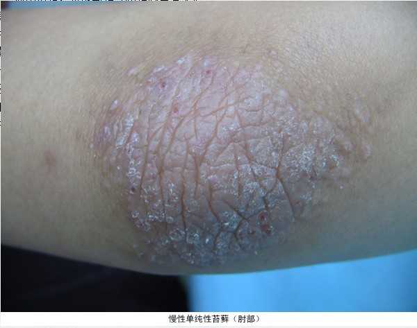 单从题主的标题出发,牛皮癣为何在国内广泛被称作神经性皮炎?