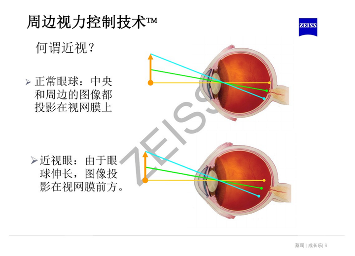 离焦镜是什么原理,真的可以缓解近视吗? - 知乎