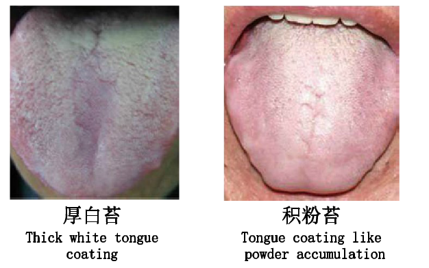 舌苔厚腻有酸腐气味，有什么办法可以去除吗？ - 知乎