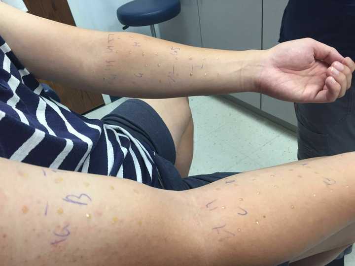 过敏源的科学依据是什么 筛查是怎么进行的 知乎