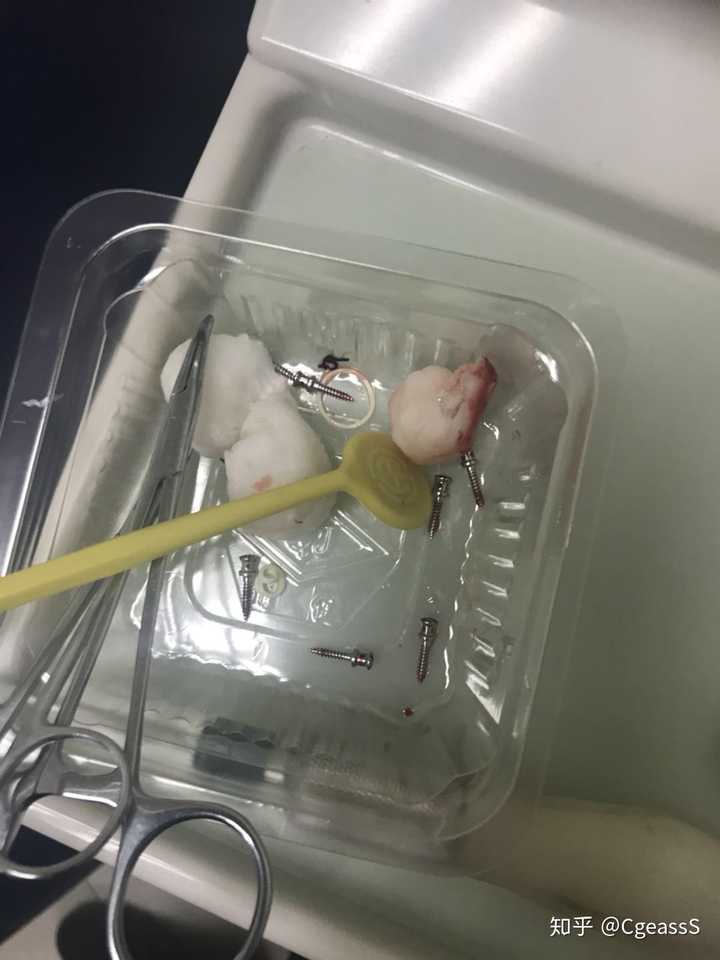 两个周之后就去第一次复诊,不打麻药拔了8个牵引钉(我是两个周拔掉,有