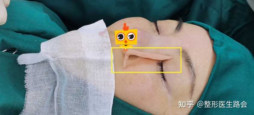 硅胶做的鼻子出现了挛缩怎么办