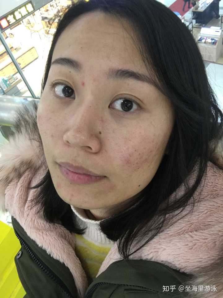 怎么看待五官漂亮但是皮肤差的女性?