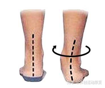 跟腱炎快3个月了，是不是变成慢性跟腱炎了 ? - 知乎