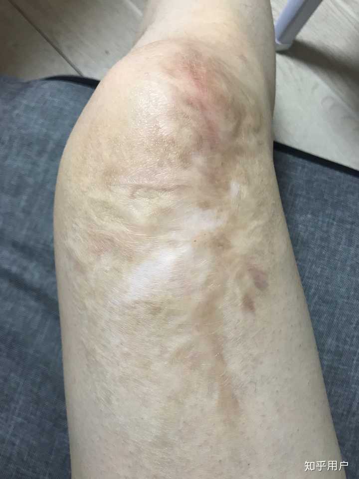 小时候烫伤的
