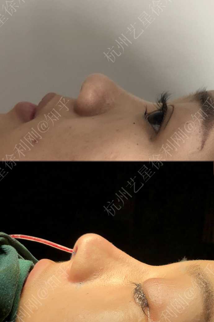 隆鼻医生徐利刚 的想法: 【术后即刻】 ——术式:"索康膨体 肋软