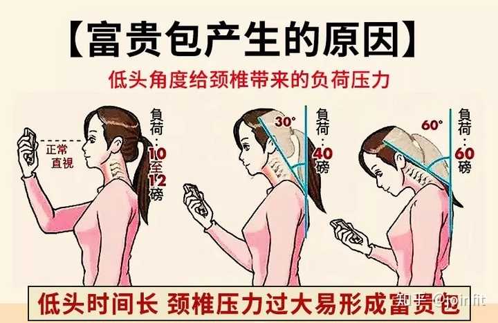 怎么矫正富贵包,骨盆前倾,我18岁是真的 同样低头玩