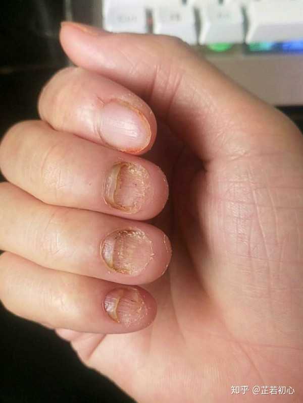 灰指甲早期症状照片图片