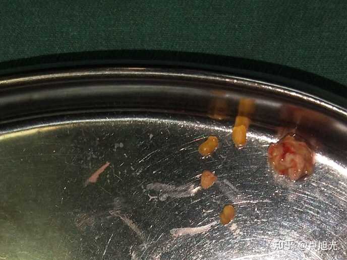 一周看了好几个颌下腺导管结石的患者 - 知乎