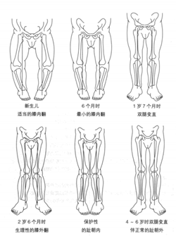 如何矫正罗圈腿(o型腿)?
