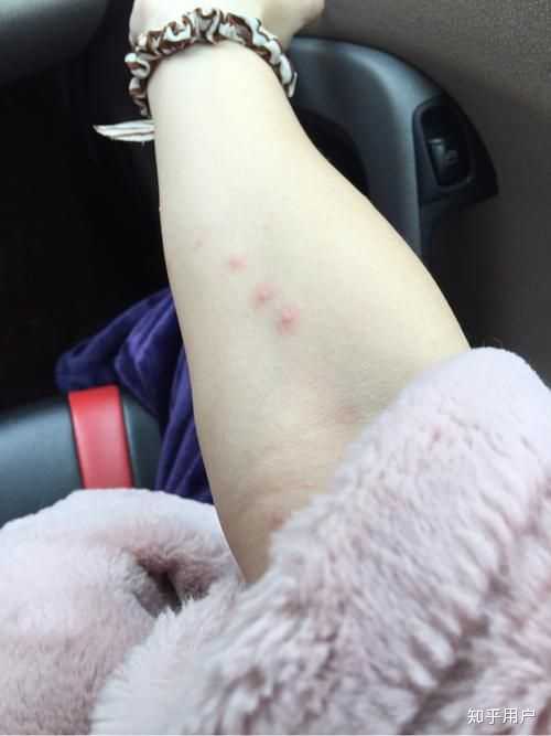 出水痘如何有效护理?有哪些禁忌?