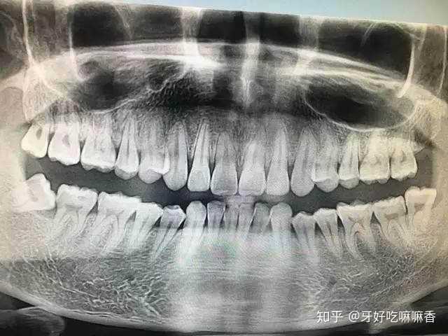 牙齒矯正方案?