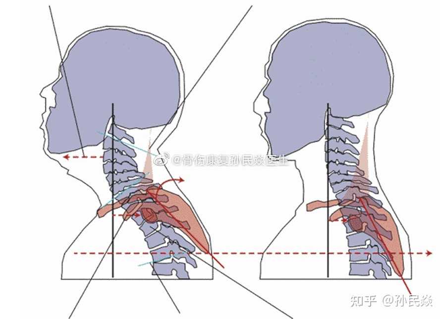 孙民焱 的想法 颈椎过伸,椎间关节容易劳损,枕下及小脑 知乎