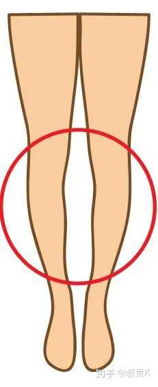 腿形:o 型腿