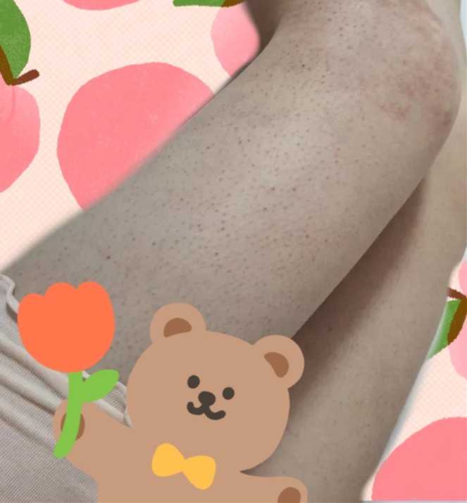 毛周角化是什么样子的？