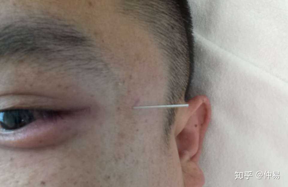 最近上火得了麦粒肿,自己针灸太阳穴一次治疗效果很明显,肿消大半并且
