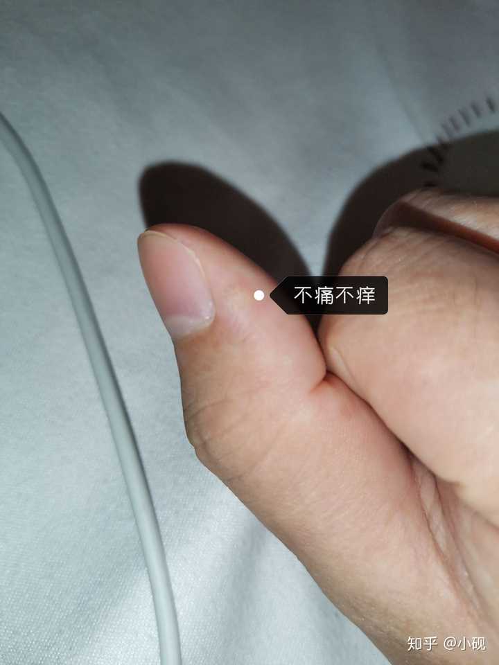 手指长了一个白色小疙瘩,戳它会有一点疼,怎么回事?