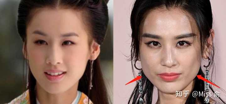 娱乐圈其实很多女明星也都出现了这样的问题,原先都是小v脸,现在都