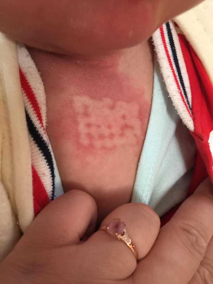 婴儿后颈部鲜红斑图片图片