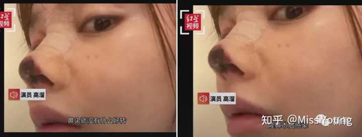 娱乐圈有哪些整容失败的案例 知乎 娱乐圈有哪些整容失败的案例 知乎