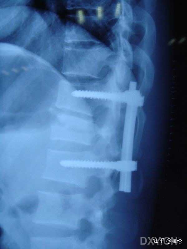 腰椎骨折是怎样的体验 治疗过程是怎样的 多久可以恢复 知乎 腰椎骨折是怎样的体验 治疗过程是怎样的 多久可以恢复 知乎