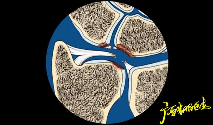 三角纤维软骨tfcc损伤该如何治疗和康复呢