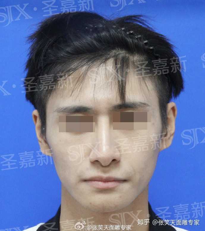 我一个男生想去削骨,可以吗?