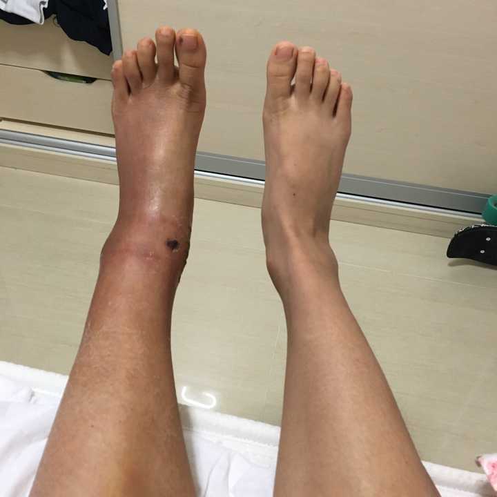 脚踝骨折怎么做才能恢复的快 知乎 脚踝骨折怎么做才能恢复的快 知乎
