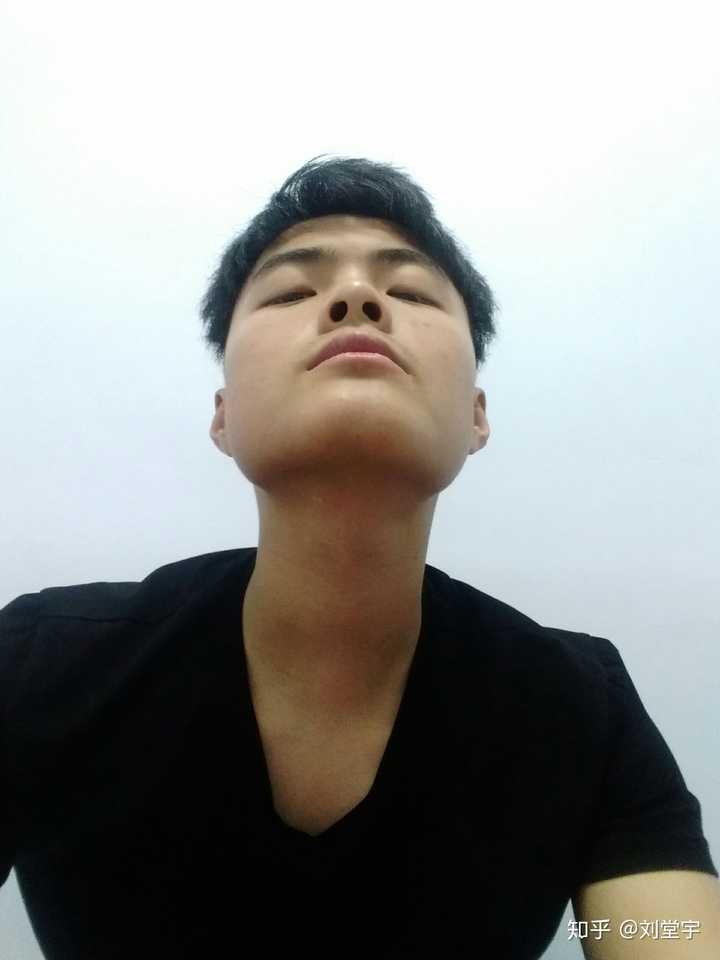 我因为下巴歪,感觉因此经常受到别人歧视,我该做手术吗?