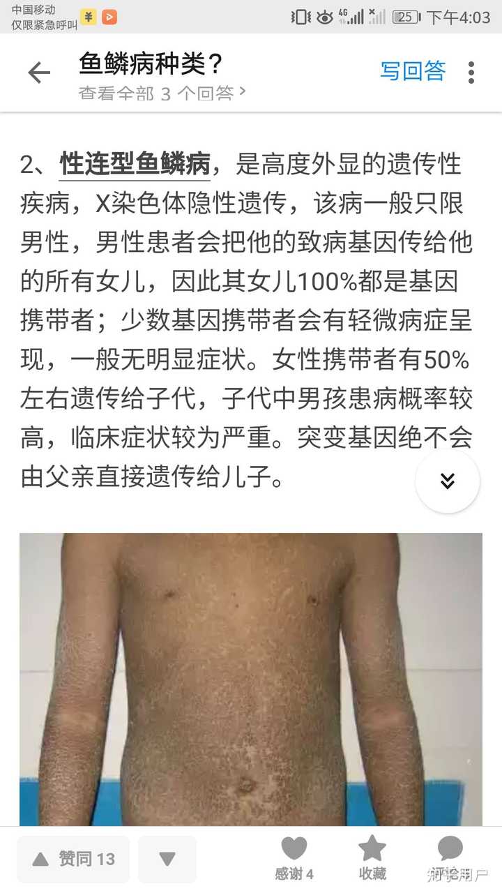 鱼鳞病还有未来吗 知乎