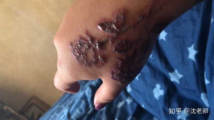 洗纹身起水泡了怎么办?