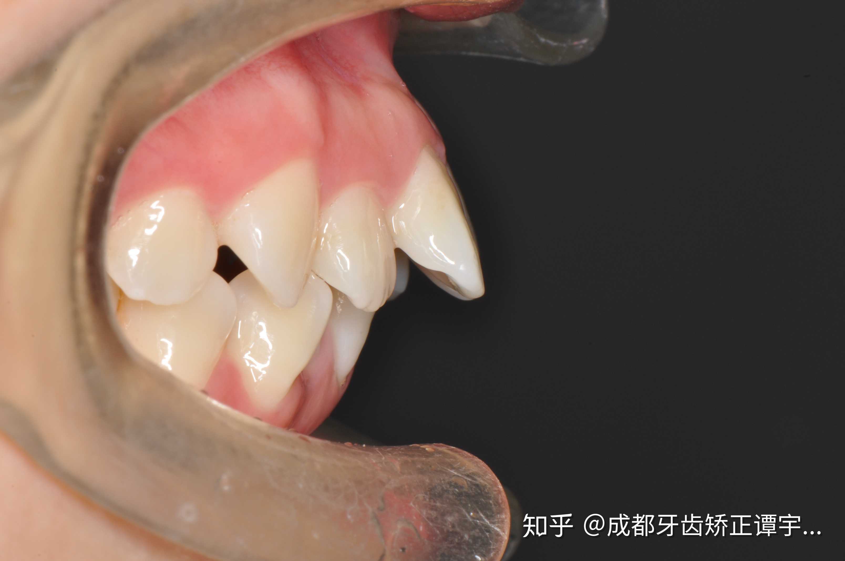 成都牙齿矫正谭宇医生 的想法: 关于骨性前突与牙性前突的表现特征
