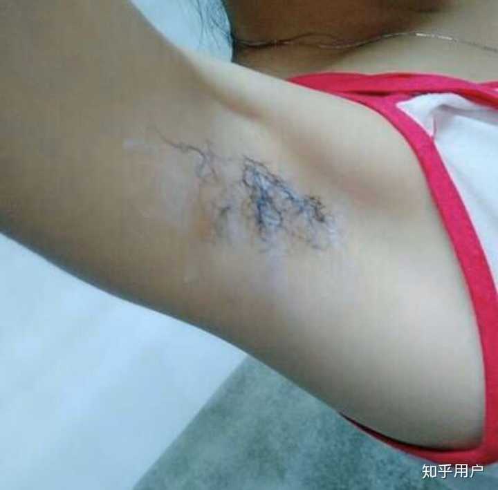 姑娘们的比基尼区怎么脱毛 知乎 姑娘们的比基尼区怎么脱毛 知乎