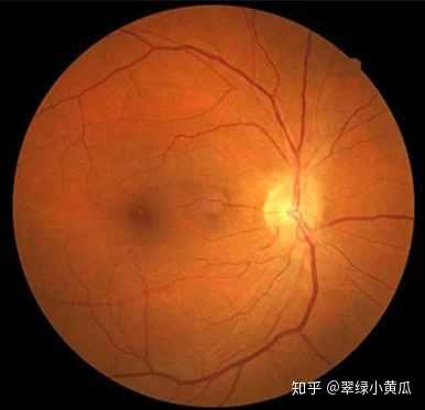 高度近视患者剧烈运动真的会视网膜脱落吗?几率大不大啊?