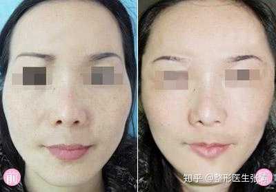 太阳穴填充前后对比