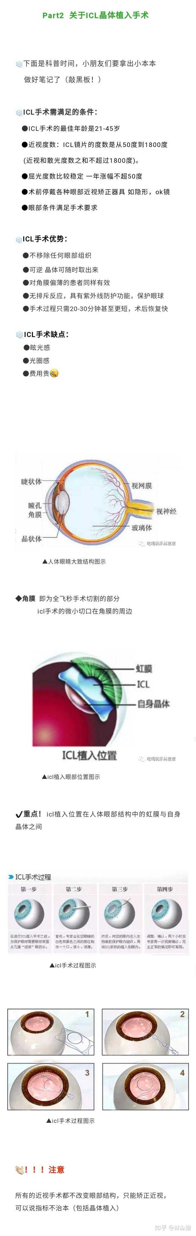谁做过icl人工晶体植入手术 知乎 谁做过icl人工晶体植入手术 知乎