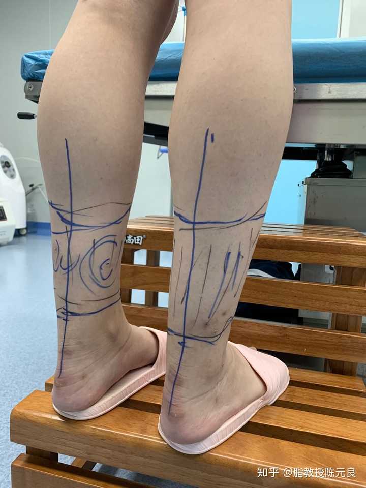 瘦小腿打瘦腿针还是抽脂好？