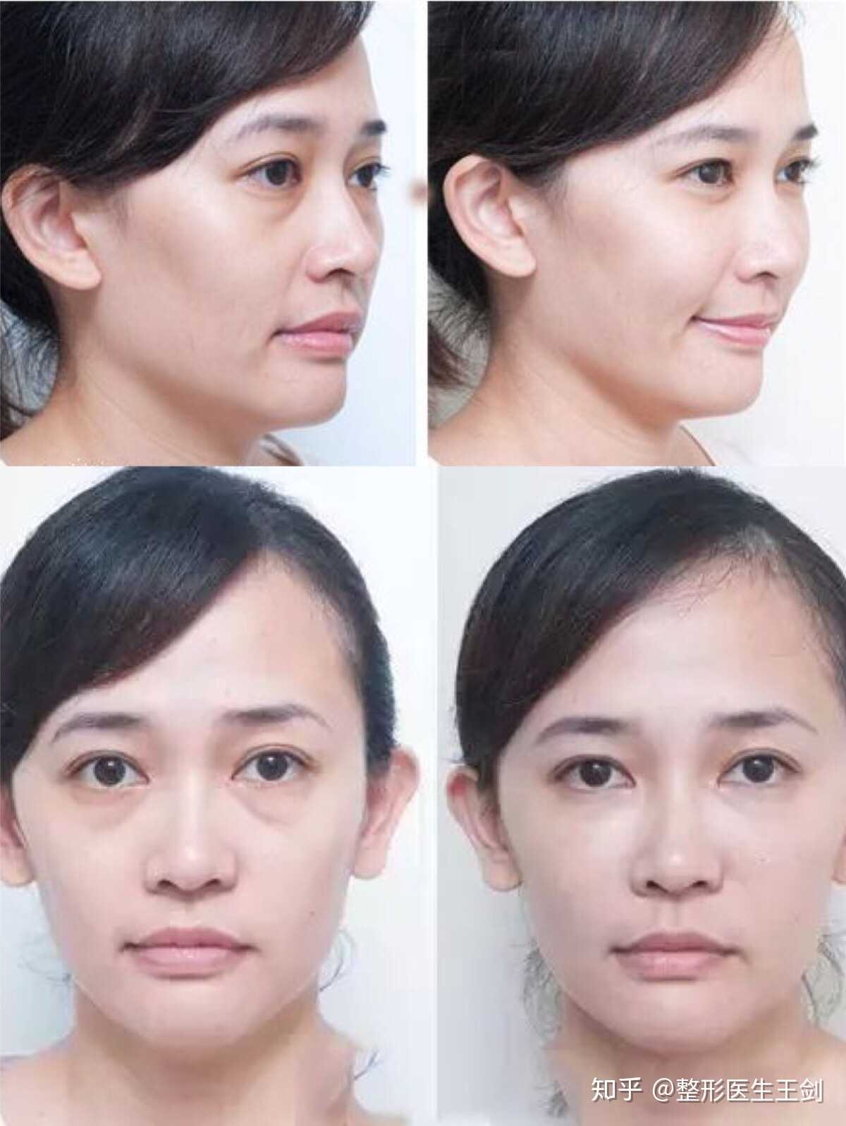 卧蚕使人甜美,眼袋显人老态