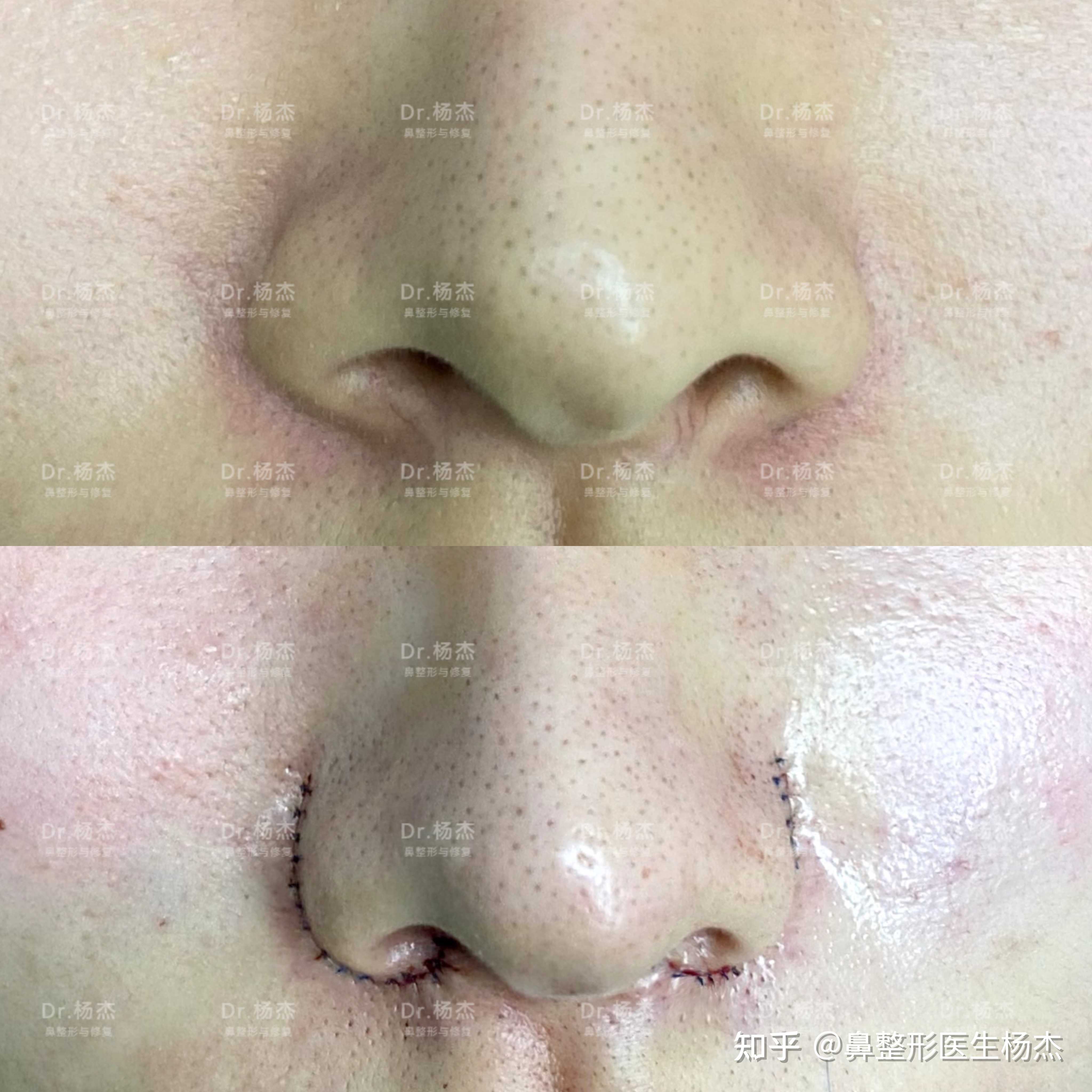 鼻翼外切缩小