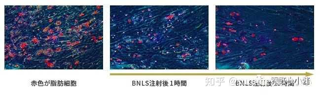 可以请学医或者医美的人谈谈溶脂针的效果或危害吗 打过的人献身说法最好了 Summer夏小小小的回答 可以请学医或者医美的人谈谈溶脂针的效果或危害吗 打过的人献身说法最好了 Summer夏小小小的回答