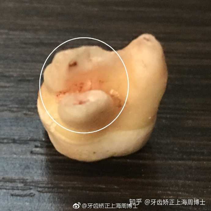 7号牙拔出来之后发现,根尖已经被智齿顶… - 知乎