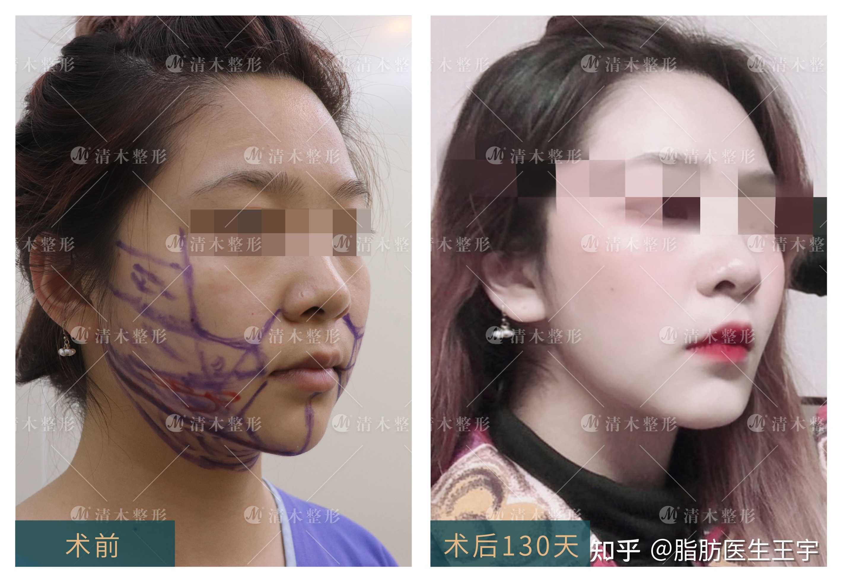 颧弓口角面颊下颌缘吸脂