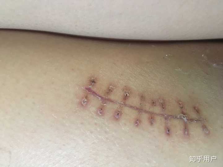 背部刀伤疤痕图片图片