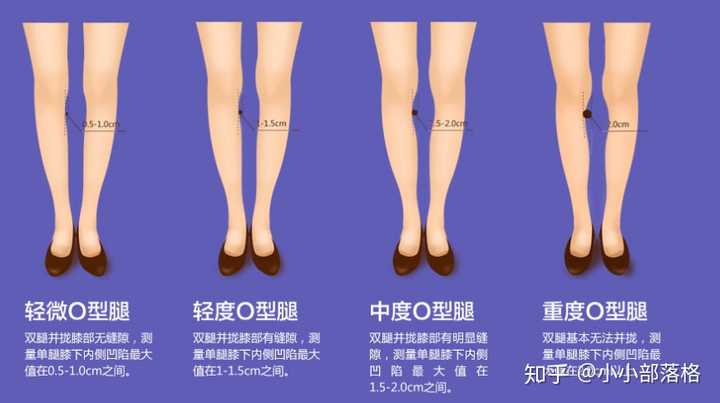 请问大家怎么判断o型腿呢