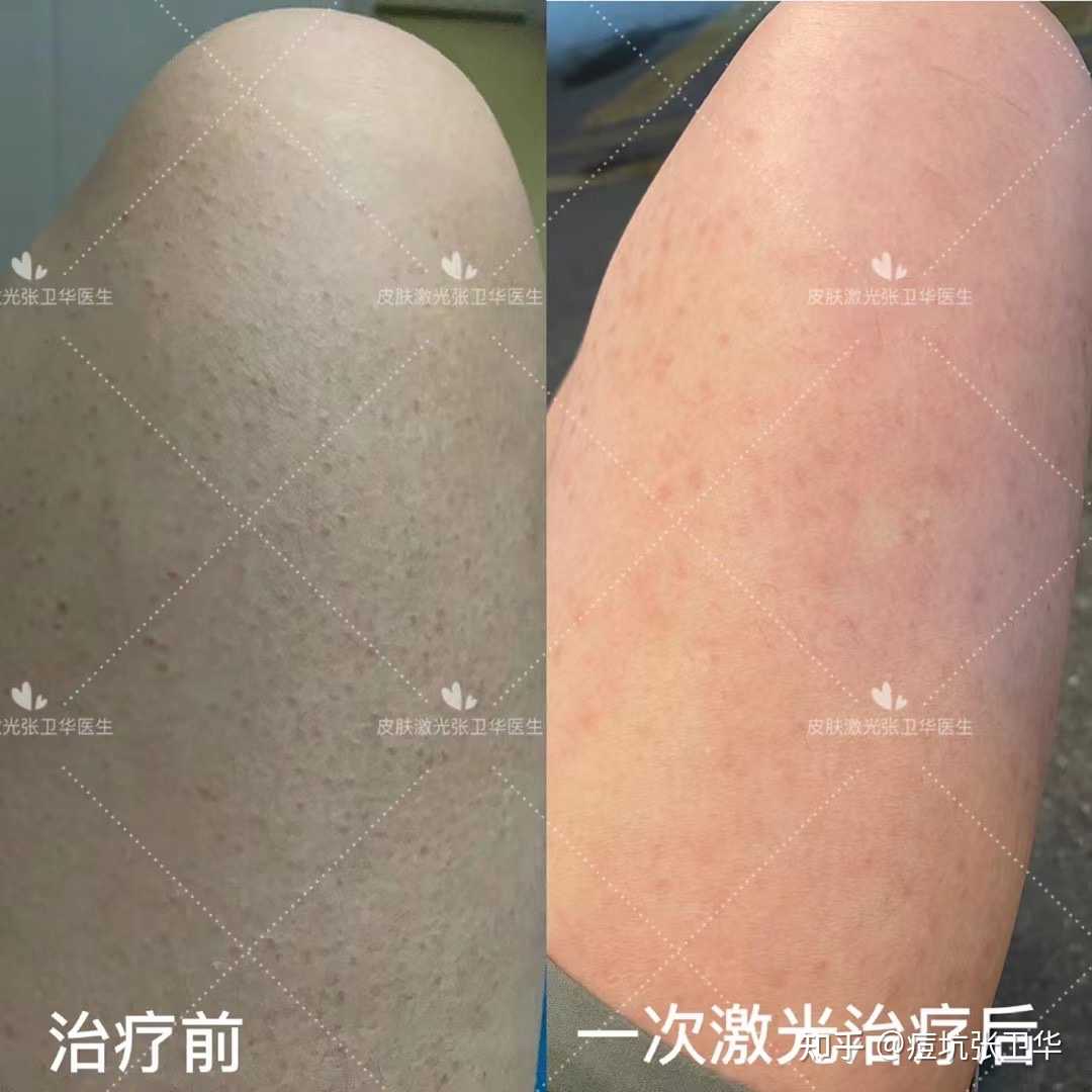 鸡皮肤激光费用(激光鸡皮肤手术哪里有)