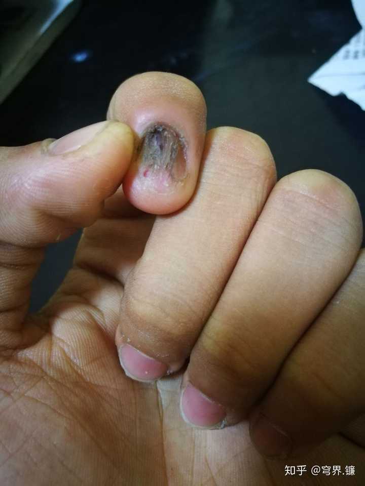 指甲上有一条淡淡黑线,怎么回事?两年了.