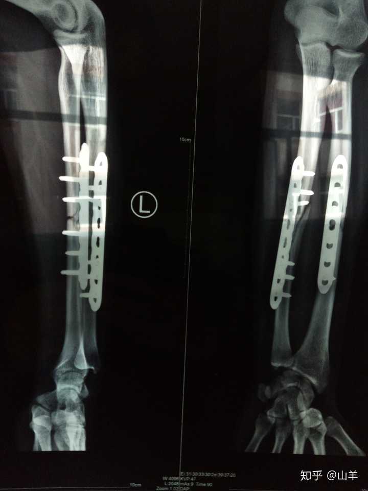 骨折时大家是怎么熬过去的 知乎 骨折时大家是怎么熬过去的 知乎