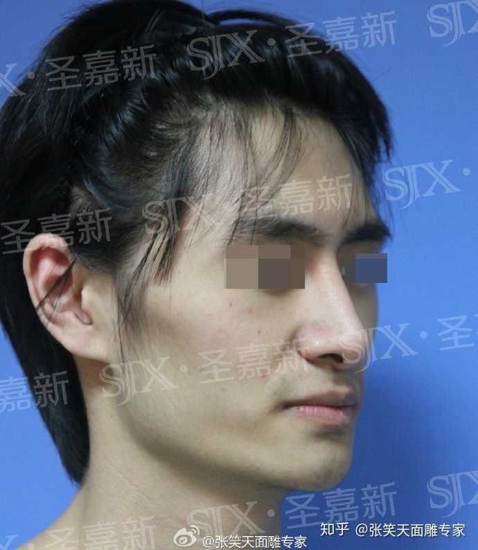 我一个男生想去削骨,可以吗?