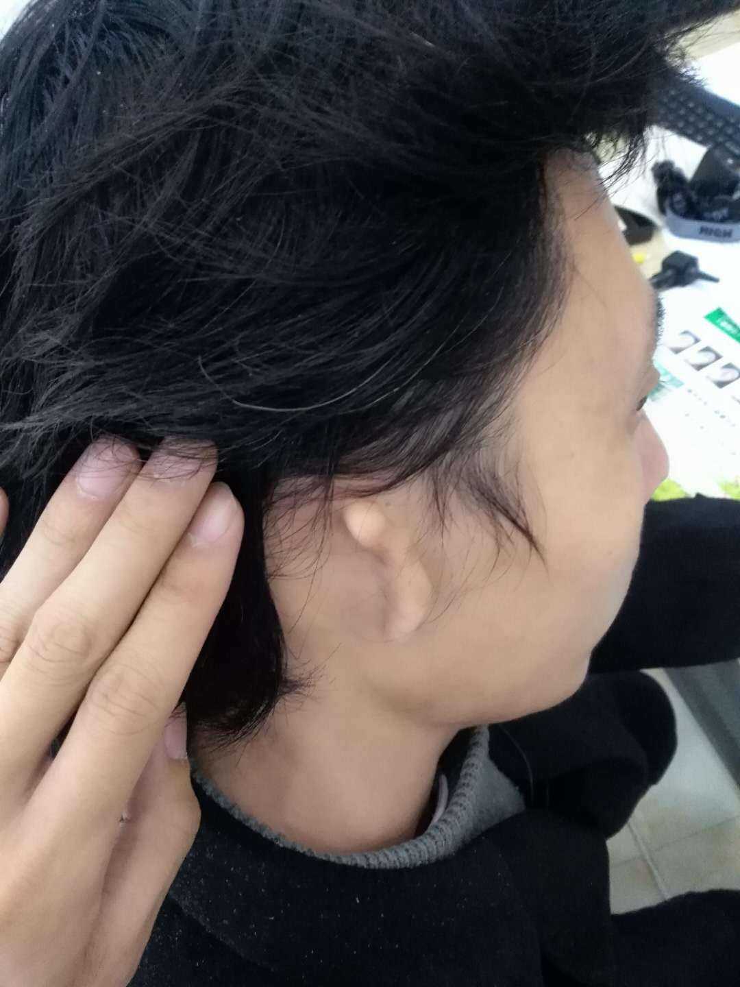 外耳道闭锁对听力的影响