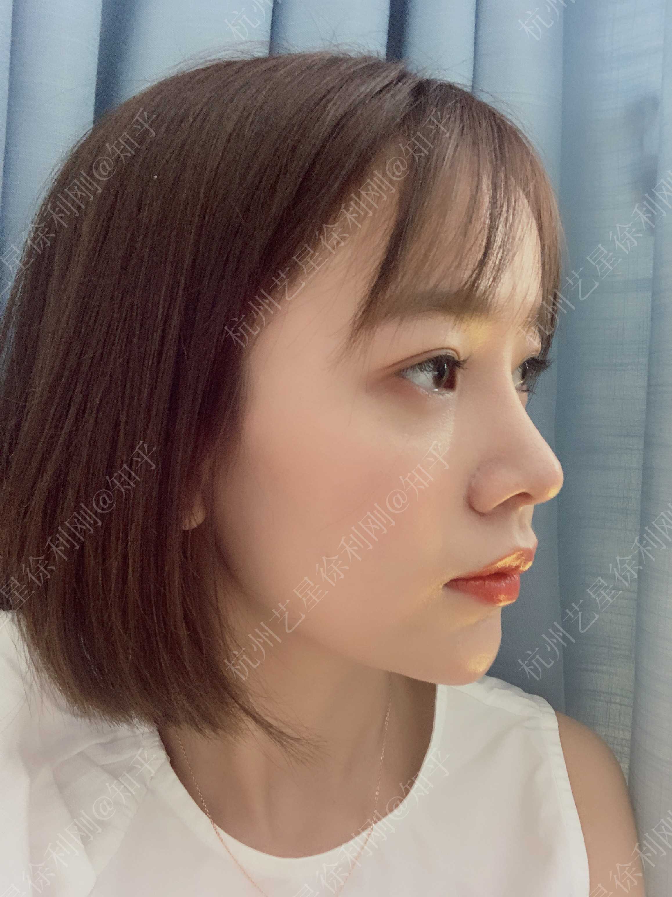 半肋鼻综合术后17天